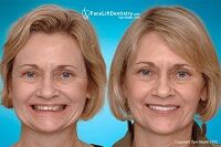 dental-facelift-vs-surgical-facelift-550 (1).jpg